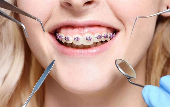 ارتودنسی دندان چیست؟ (3)