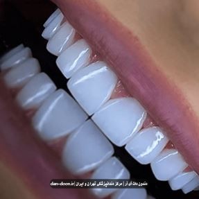 راهنمای جامع زیبایی با کامپوزیت دندان + مقالات علمی ( گردآوری از دندون دات آی آر ) کامپوزیت دندان