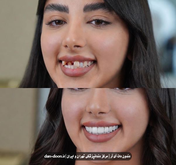 لمینت دندان در تهرانپارس