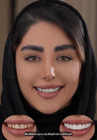 لمینت دندان در تهرانپارس