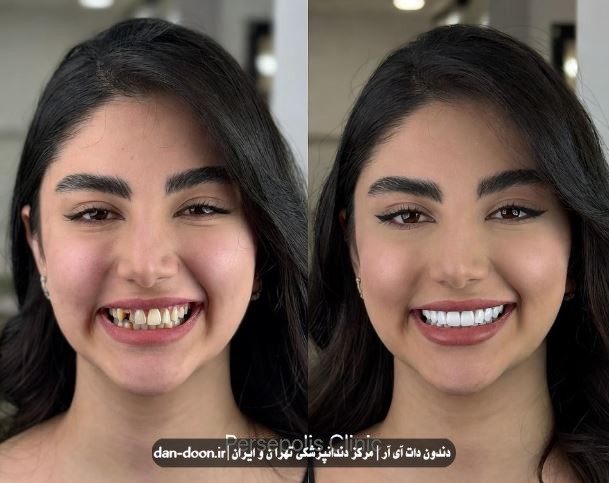 لمینت دندان در تهرانپارس